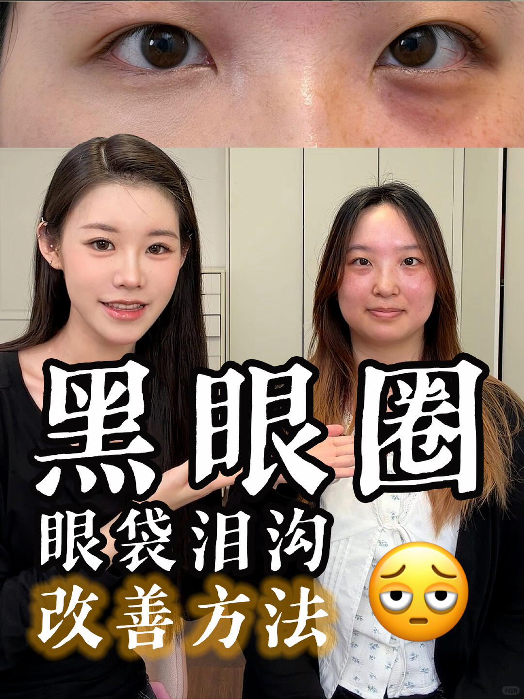 黑眼圈眼袋
